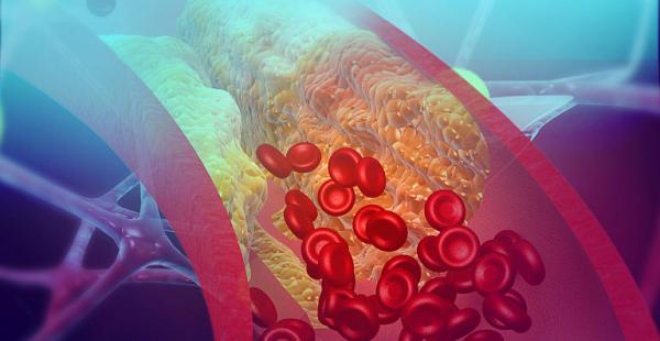 Vasculita necrozanta: afectiune care poate afecta orice vas de sange Vasculita necrozanta: afectiune care poate afecta orice vas de sange
