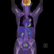 diagnosticare cancer