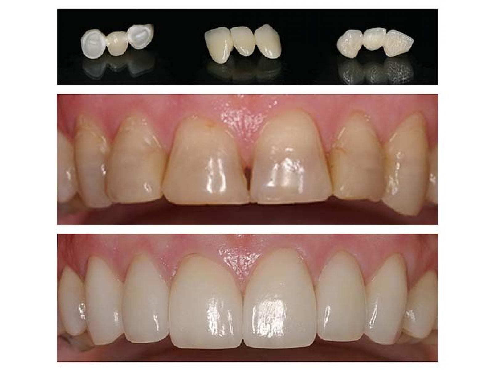 Premium Dental - Clinica de estetica dentara - lava_restorations.jpg