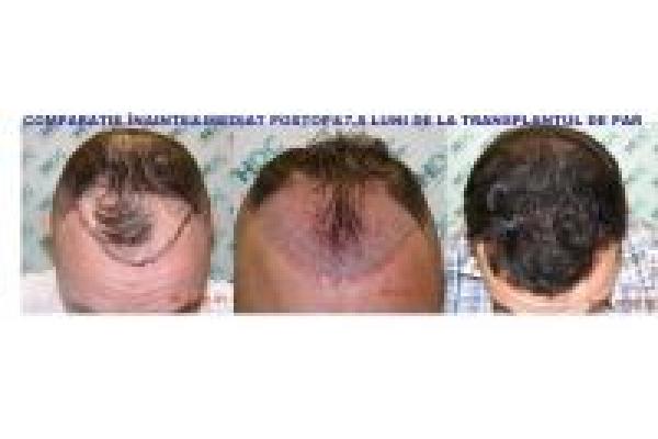 Implant de Par HDC - COMPARISON_BEFORE-IMMED-AFTER.jpg