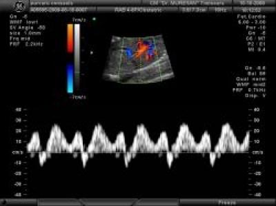 Importance of the 11-13 weeks scan