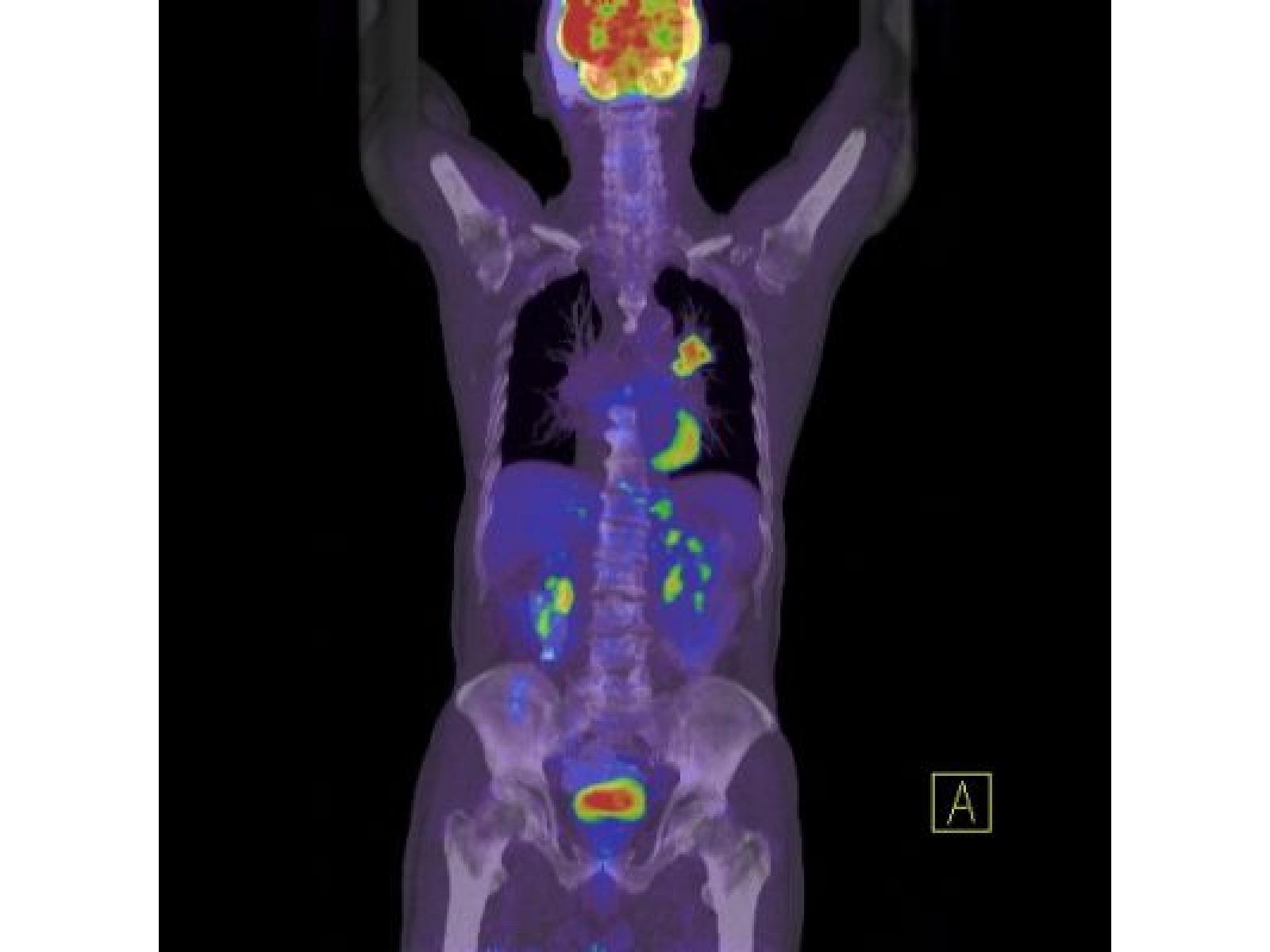 Centrul de Diagnostic Pozitron Diagnosztika PET CT - rezultat_PET-CT.jpg