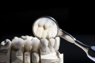 Ceramica integral ( E-max Ivoclar) folosita ca optiune pentru incrustatii si fatete ceramice