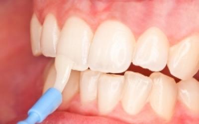 Fluorizarea si desensibilizarea dentara