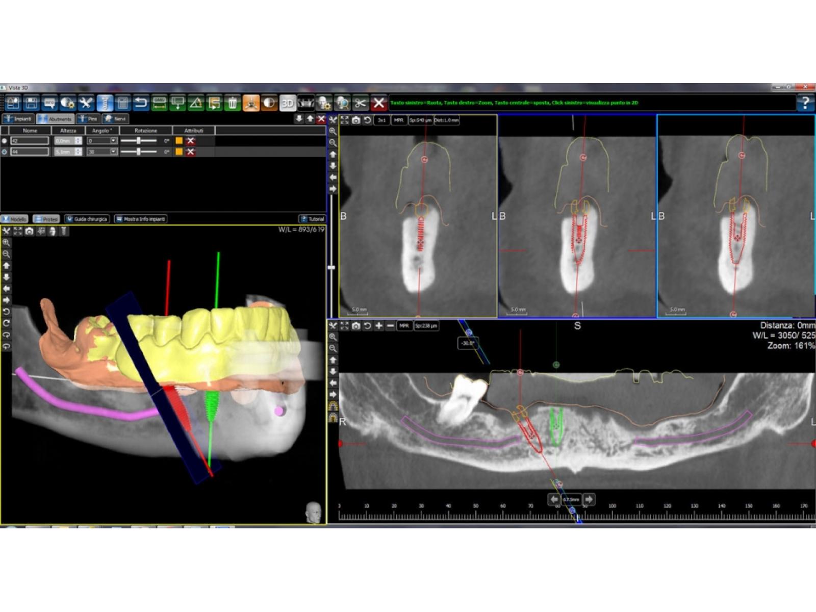 Dr.Cristian Gheorghiu - medic dentist implantolog - 1planificare_3d.jpeg