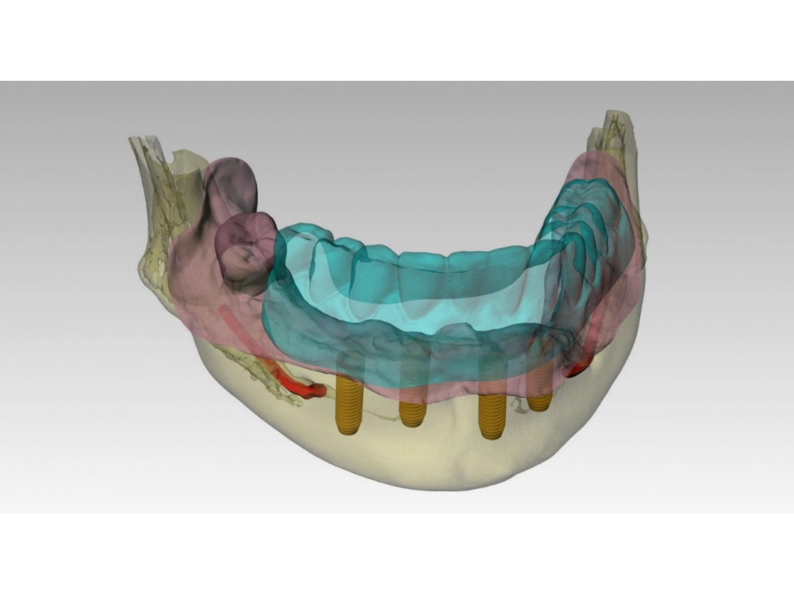 Dr.Cristian Gheorghiu - medic dentist implantolog - 2planificare_3d.jpeg