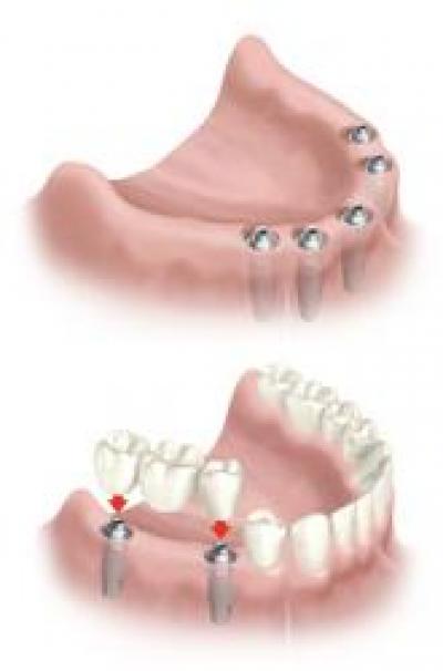 Sfaturi pentru purtatorii de proteze