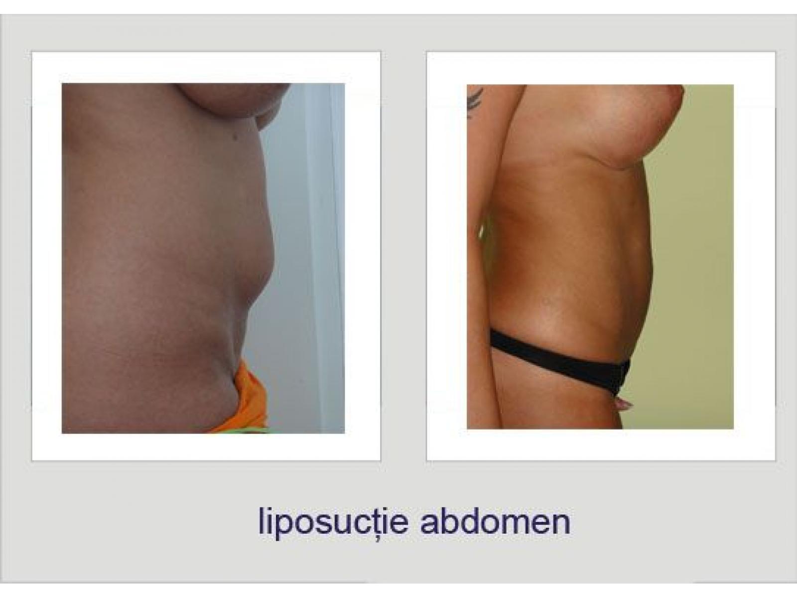 Dr. Lucian Fodor - liposuctie_abdomen2.jpg