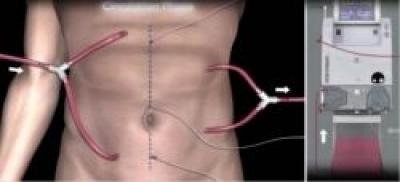 Ce este chimioterapia hipertermica intraperitoneala?