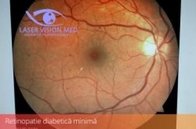Laserul în RETINOPATIA DIABETICĂ