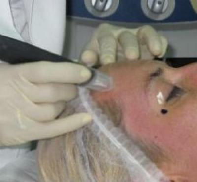 Microdermabraziunea si mezoterapia virtuala