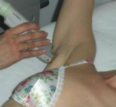 Tratamente laser si IPL pentru pete pigmentare, cuperoza, epilare definitiva, etc.