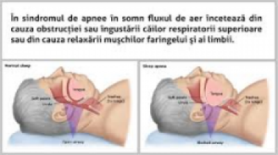 Sindromul de apnee in somn