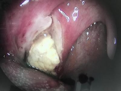 Reductia amigdaliana , criptoliza amigdaliana