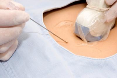 Amniocenteza – analiza care iti da raspunsuri despre bebelusul tau