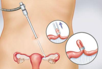 Cand vrei sa nu mai vina barza: legarea trompelor ca metoda contraceptiva