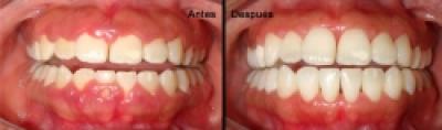 Remodelarea gingivala, un pas in plus catre un zambet de nota 10