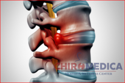 Hernia de disc - diagnostic şi tratament