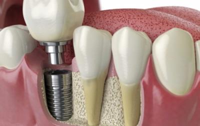 Implant dentar intr-o zi