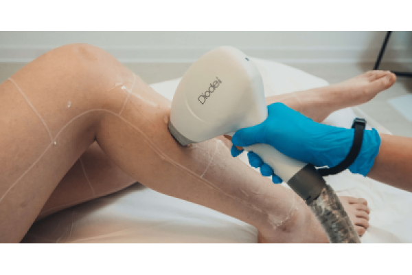 Episculpt Beauty Sibiu - procedura_epilare_definitiva_cu_laser.png