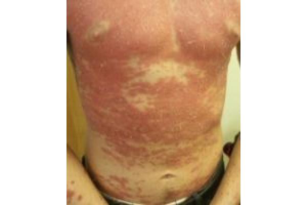 Clinica Psoremiss - psoriazis1.jpg