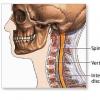 Hernia de disc cervicala