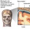 Meningita - inflamatia meningelor