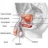 Prostatita - inflamatia prostatei