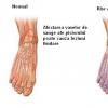 Metode de ingrijire a membrelor inferioare la persoanele cu diabet zaharat