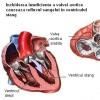 Insuficienta aortica (regurgitarile de valva aortica)