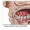 Bolile gingiilor (gingivita si paradontopatia)