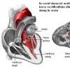Stenoza aortica