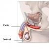 Hidrocelul congenital