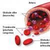 Anemia feripriva (prin carenta de fier)