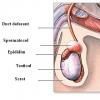 Spermatocelul (chistul epididimal)