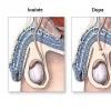 Vasectomia - Sterilizarea definitiva