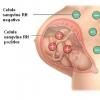 Sensibilizarea la antigenul Rh in timpul sarcinii