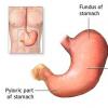 Cancerul gastric