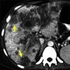 Screeningul cancerului hepatocelular