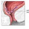 Hemoroizi- Informarea pacientului