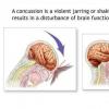 Leziunile traumatice craniocerebrale (Comotia cerebrala)