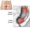 Prolaps de organe pelvine