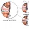 Leziunile ligamentelor colaterale mediale sau laterale ale genunchiului