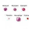 Leucemia mieloida acuta la adulti