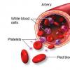 Leucemia mieloida acuta la copii si alte malignitati mieloide