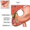 Pancreatita cronica (Inflamatia cronica a pancreasului)