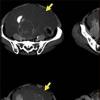 Sindromul ascitic (acumularea de lichid in abdomen)