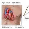 Cardiomiopatia restrictiva