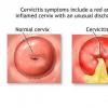 Boli ale aparatului genital feminin - generalitati (vaginita, metrita, anexita)