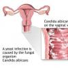 Candida (factori de risc, masuri de prevenire)